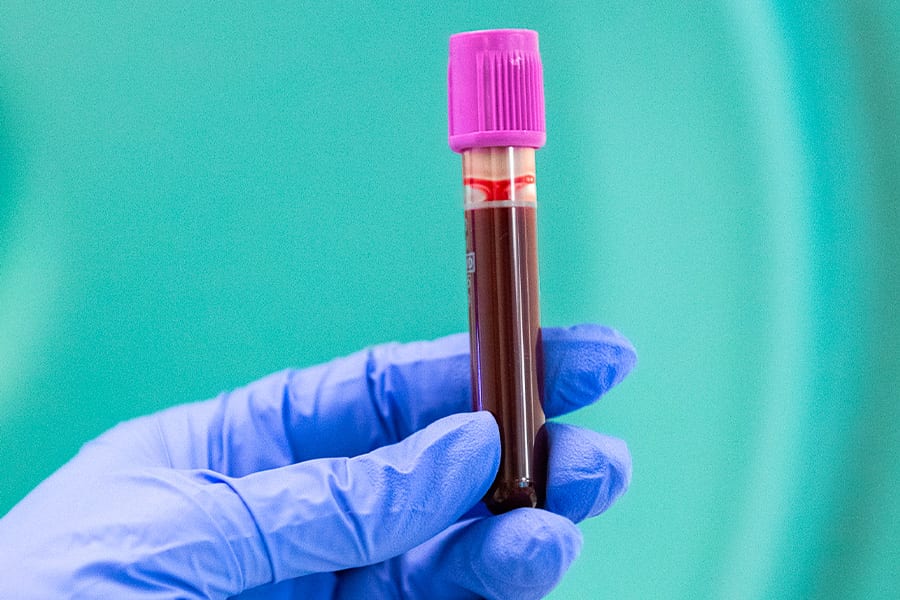biomarkers innovations innovhem biotech research sickle cell disease